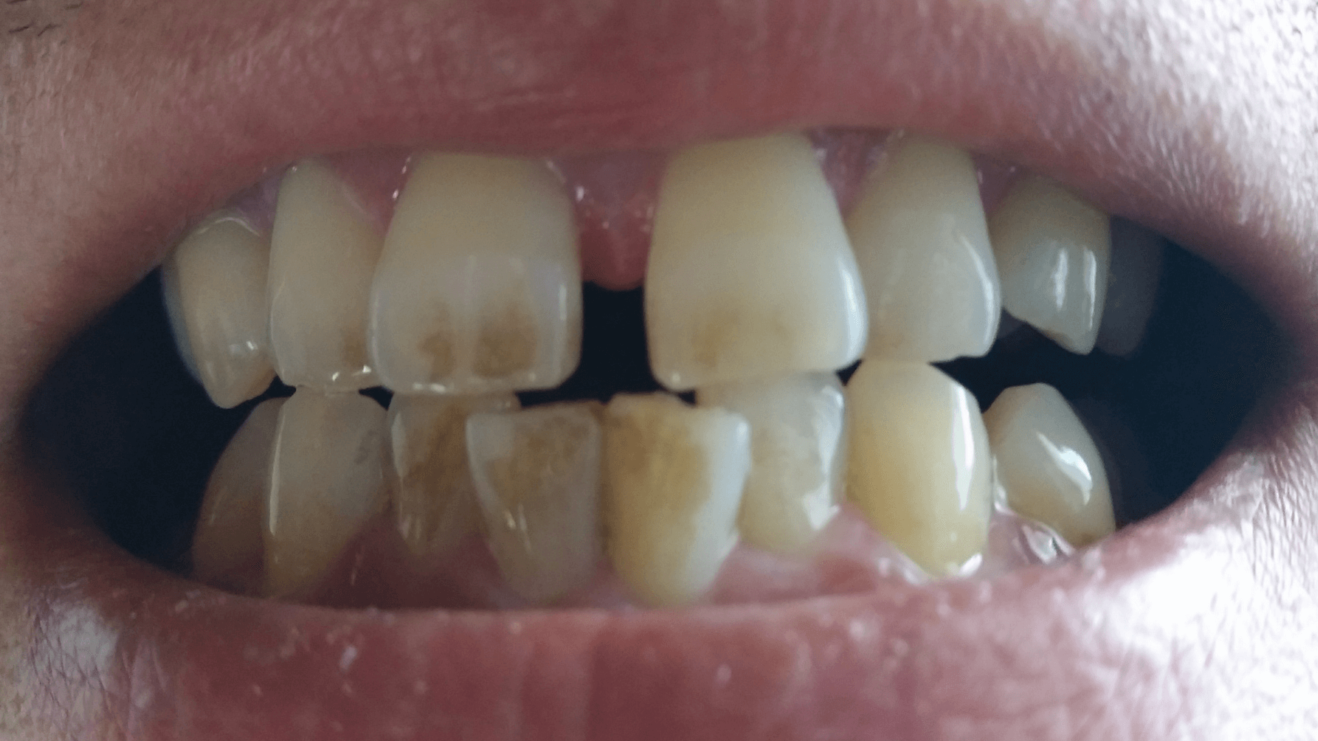 汚い歯の黄ばみ、汚れを落として白い歯にする
